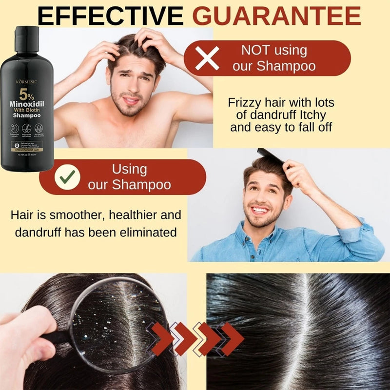 Minoxidil 5% Hair Grower Shampoo with Biotin for Hair Loss Treatment Regrowth Hair